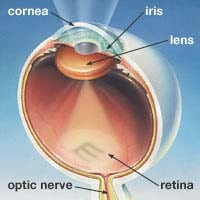 Cataract2 1